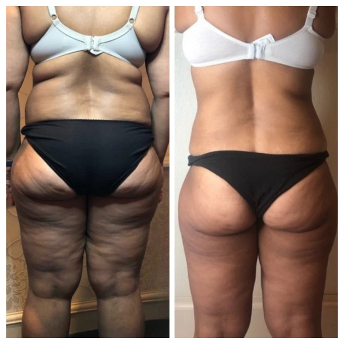 After cellulite & skin-tightening treatment