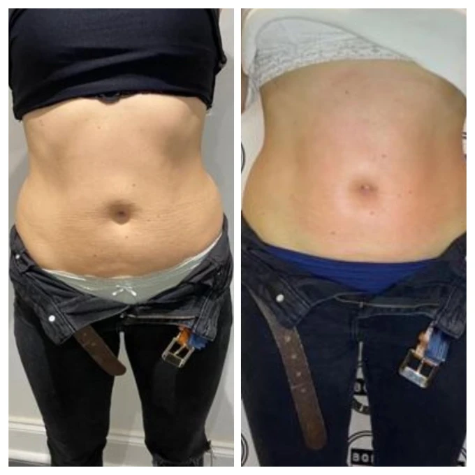 After skin-tightening and cellulite treatment