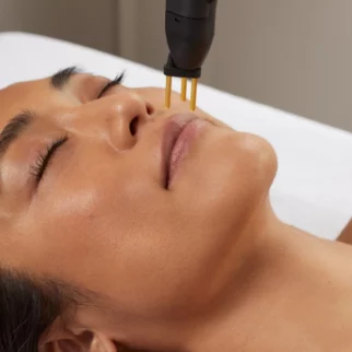 Professional NeoGen plasma facial treatment targeting the perioral area.