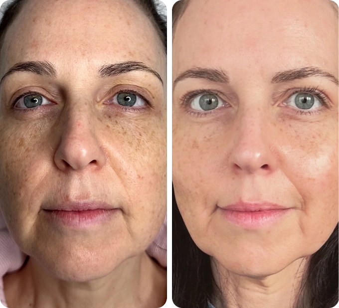 Neogen Plasma Treatment:2 Weeks After Medium Energy Treatment