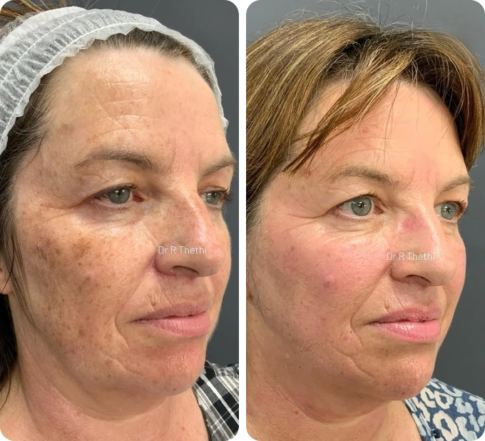 Neogen Plasma Treatment:2 Weeks After Treatment